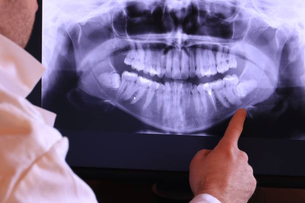 Best Emergency Wisdom Teeth Removal in Clyde, OH